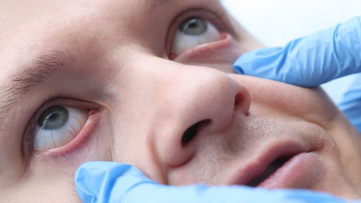 What to Do During an Ocular Emergency